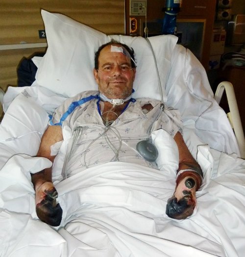 O norte-americano Paul Gaylord contraiu a peste bubônica em 2014, e teve que passar quase um mês no hospital em tratamento. Ele perdeu os dedos das mãos e dos pés devido a gangrena dos bubões. Hoje em dia a peste bubônica é tratada com antibióticos pesados.